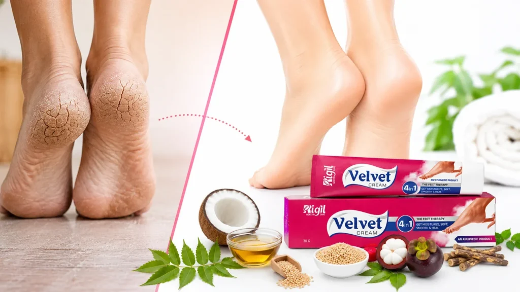 Ayurvedic Cream for Cracked Feet: Benefits, Key Ingredients, How to Use & Daily Foot Care Guide